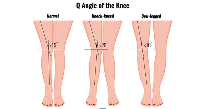 Q Angle & Knee Rehabilitation - Sportsinjuryclinic.net