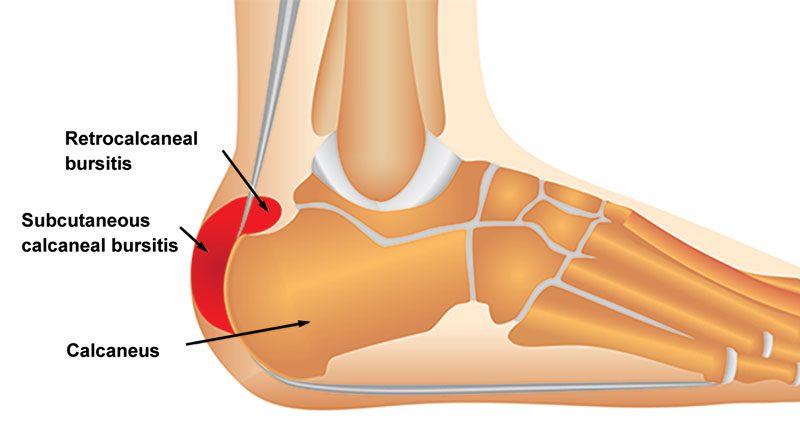 Achilles Bursitis Retrocalcaneal Bursitis Symptoms Causes Treatment