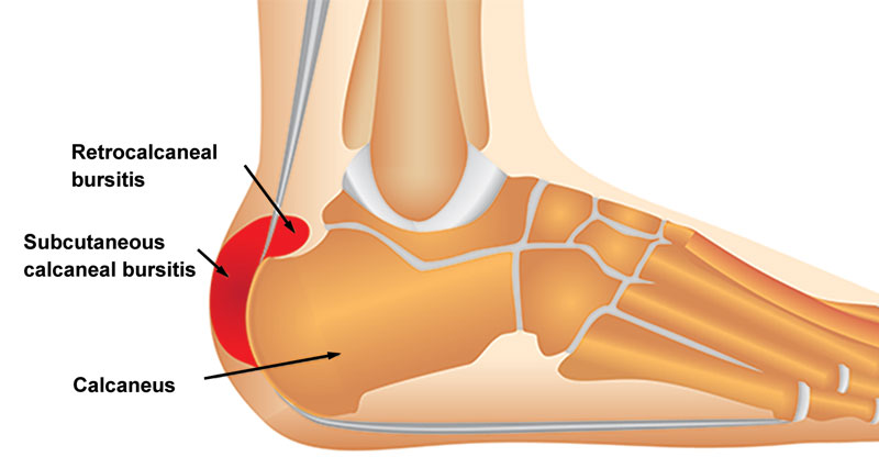 Retrocalcaneal bursitis