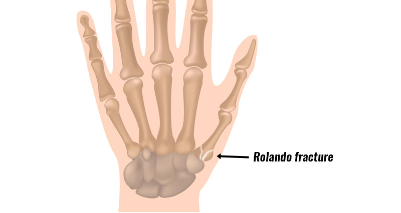 Rolando fracture