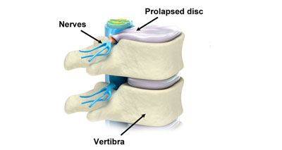 Prolapsed disc causes butock pain