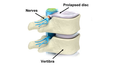 Prolapsed disc causing referred hamstring pain