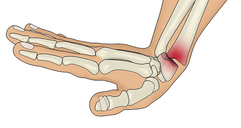 Smith fracture