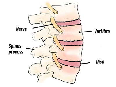 Spondylosis spine