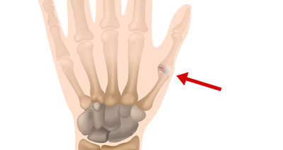 Thumb sprain