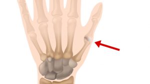 Thumb sprain
