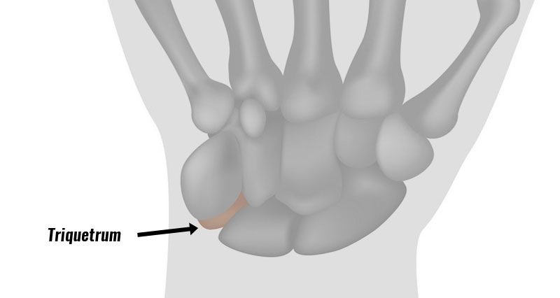 Triquetrum fracture