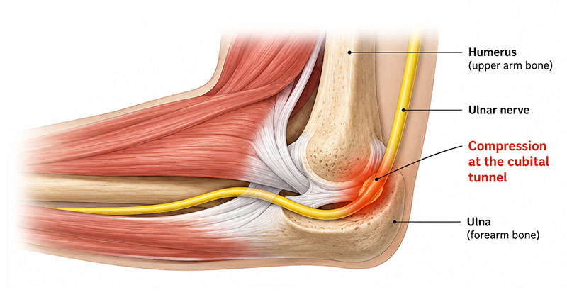 ulnar-nerve-compression800 ulnar nerve compression
