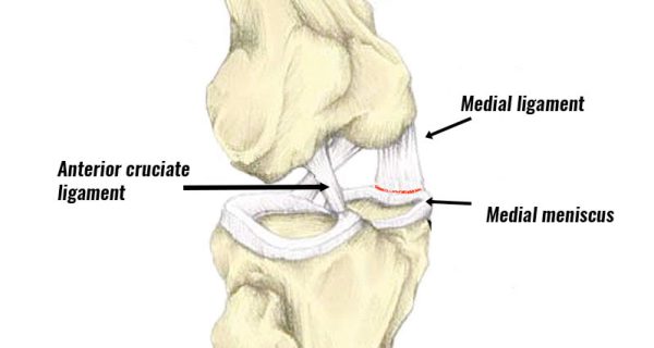 Unhappy triad of the knee