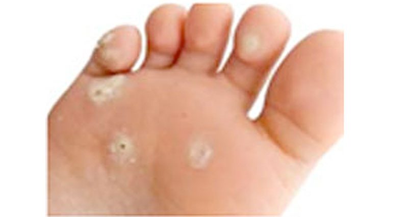 Verruca foot treatment. Hpv warts on bottom of feet, Wart on foot with black spots