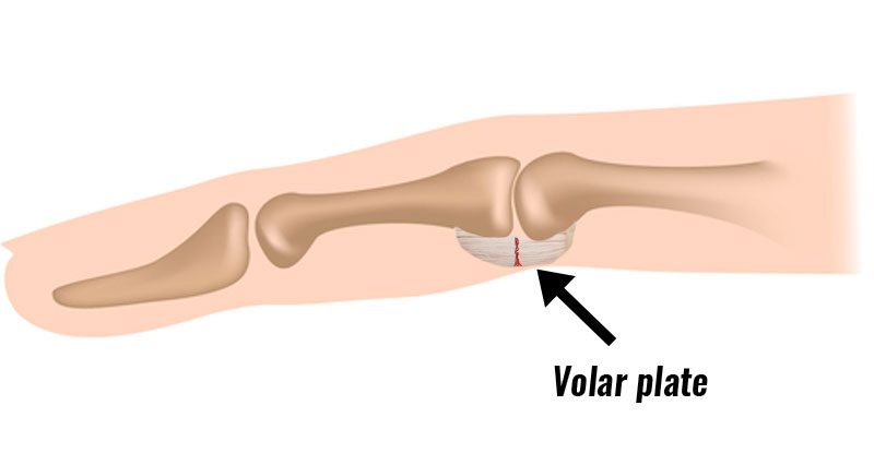 Volar plate injury