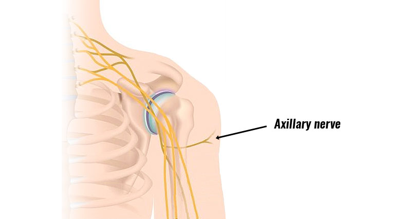 Axillary nerve injury