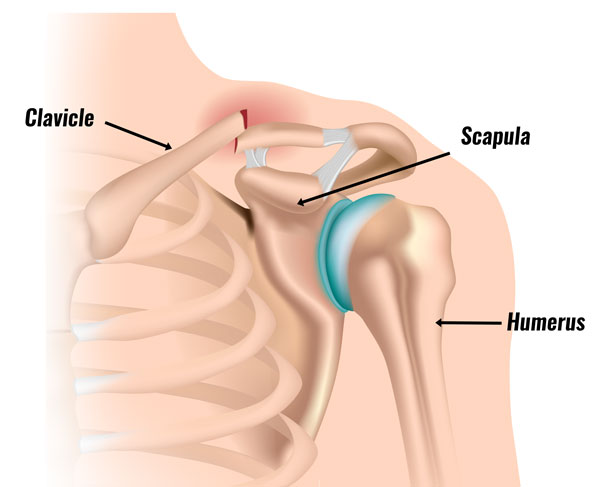 Clavicle fracture - broken collar bone