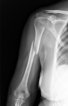 humerus fracture xray