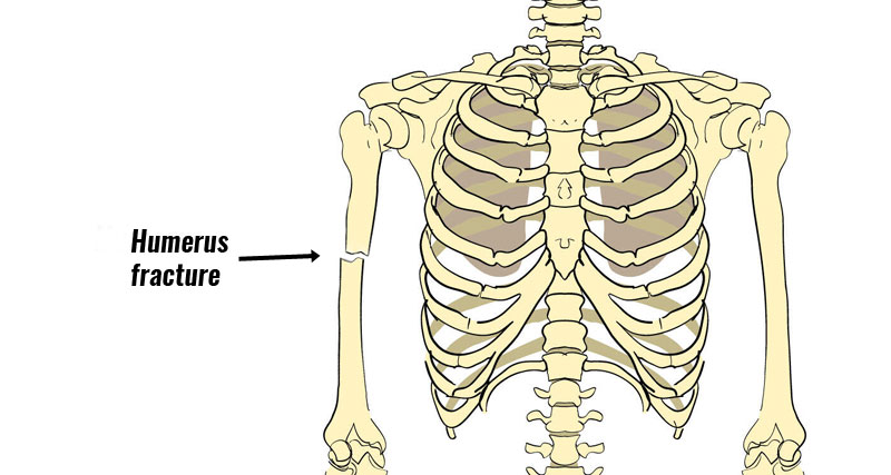 Humerus Fracture - Symptoms, Causes, Treatment & Rehabilitation