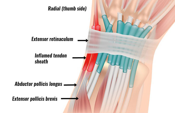 De Quervain's tenosyovitis
