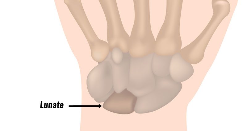 Lunate bone Kienbock's disease