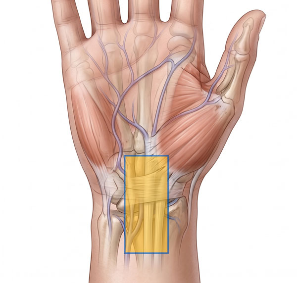 volar-central-wrist-pain600
