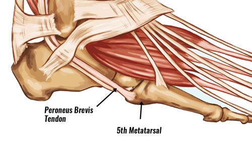 Peroneus brevis tendon insertion