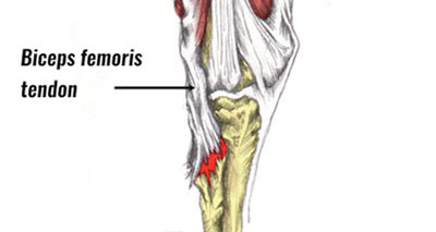 Biceps femoris avulsion