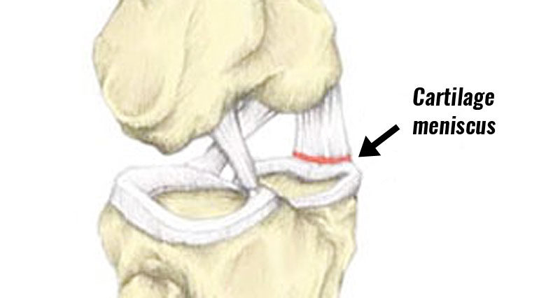 Torn cartilage inside knee pain