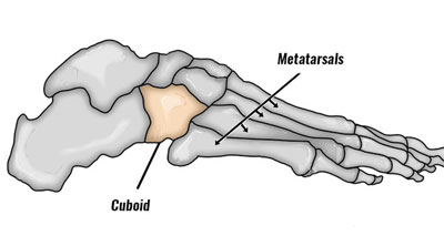 Cuboid syndrome