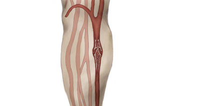 pain in calf muscles