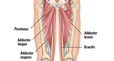 Groin pain from muscle sprain