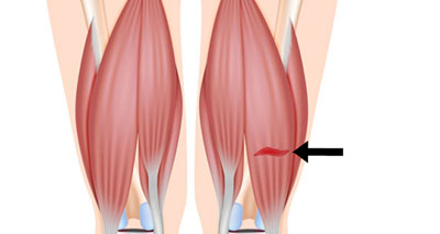 Hamstring strain posterior thigh pain