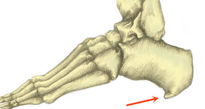 Heel spur foot arch pain