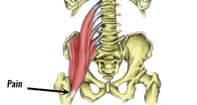 Groin injury