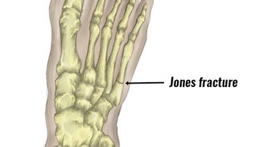Jones fracture