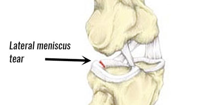 lateral knee pain meniscus tear