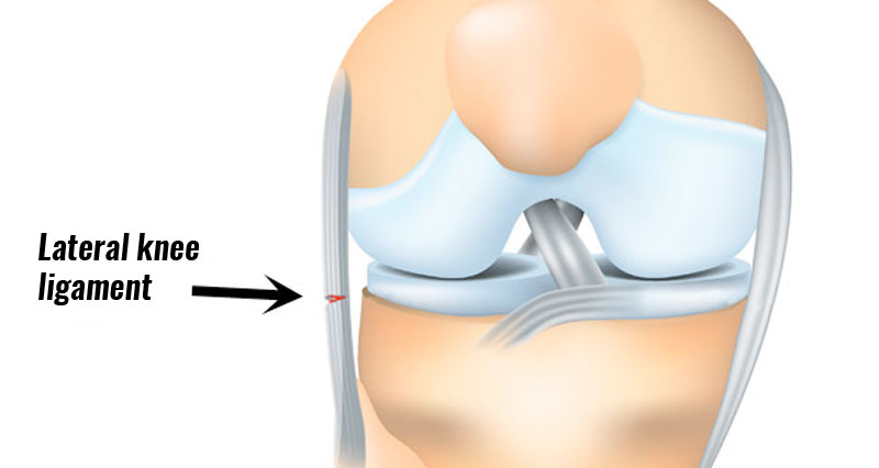 Lateral collateral knee ligament sprain