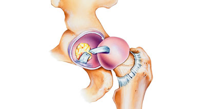 Ligamentum teres tear