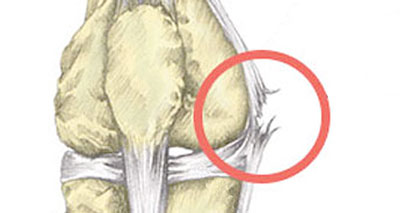 Medial Knee Pain Inside Symptoms