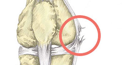 Medial Knee Pain Inside Symptoms Causes Treatment Rehab