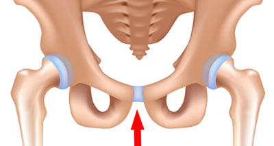 Osteitis pubis