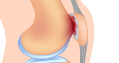 Patellofemoral pain causes lateral knee pain