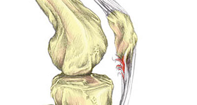 Rupture du tendon rotulien
