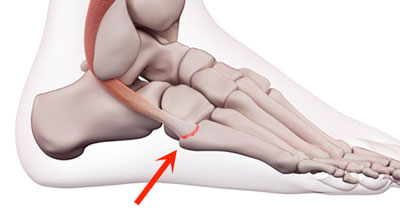 Peroneus brevis tendon strain