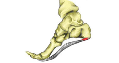 Plantar fasciitis foot arch pain