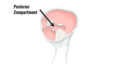 Posterior compartment calf pain