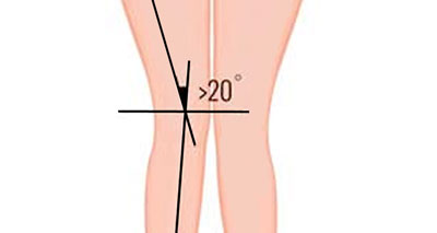 q angle of the knee