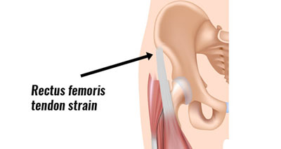 Front thigh pain tendon strain