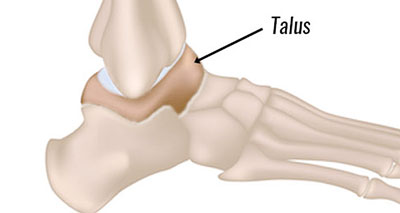 Talar stress fracture