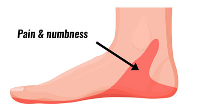 Tarsal tunnel syndrome medial ankle pain
