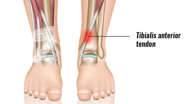 Tibialist anterior tendonitis