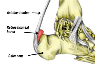 Achilles bursitis