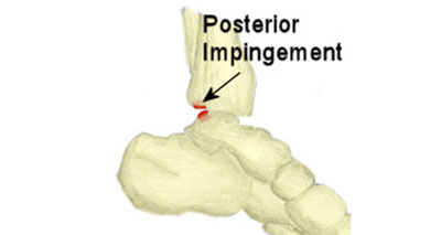 Posterior ankle impingement